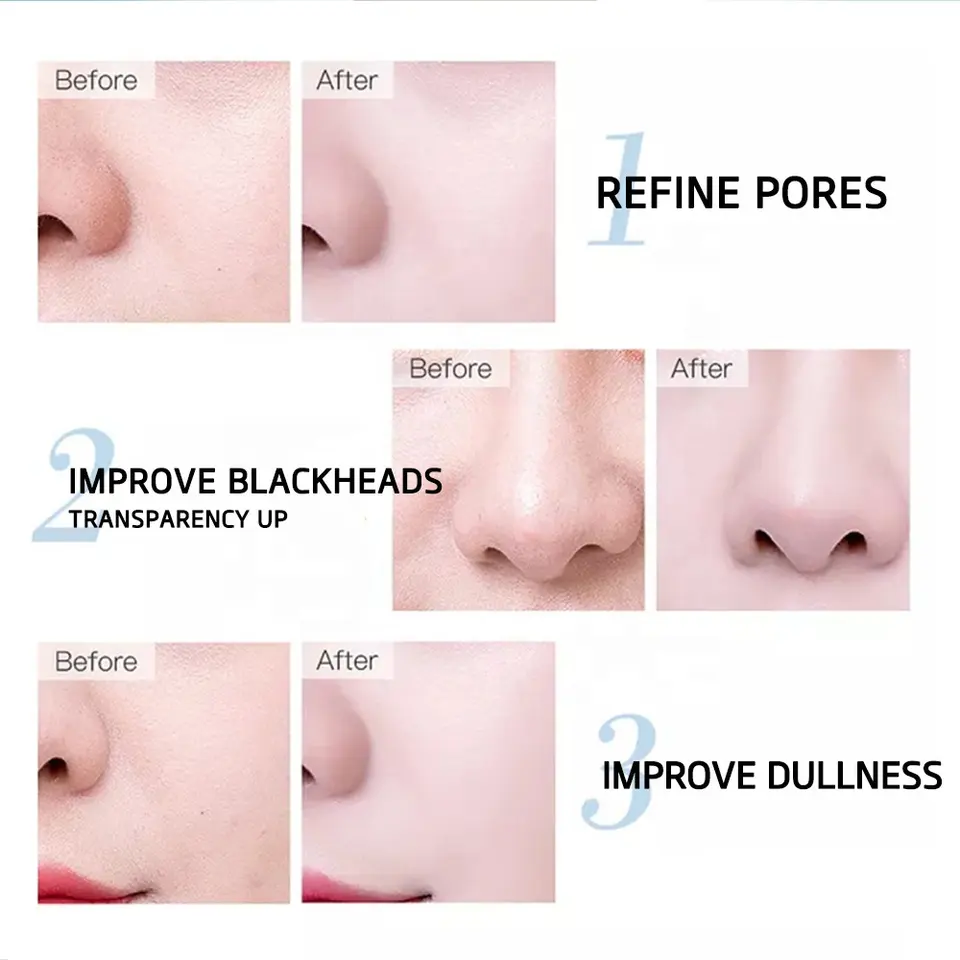 Before and after results demonstrating the effects of pure hyaluronic acid serum on skin pores and dullness